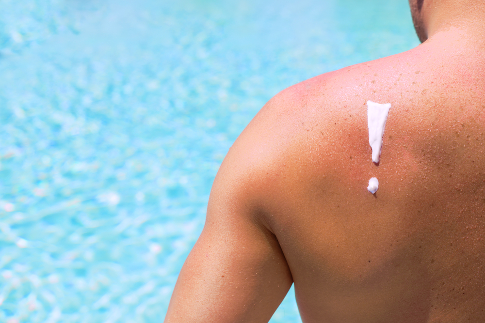 Ustioni e scottature solari, ecco 5 cose da NON fare rimedi scottature sole