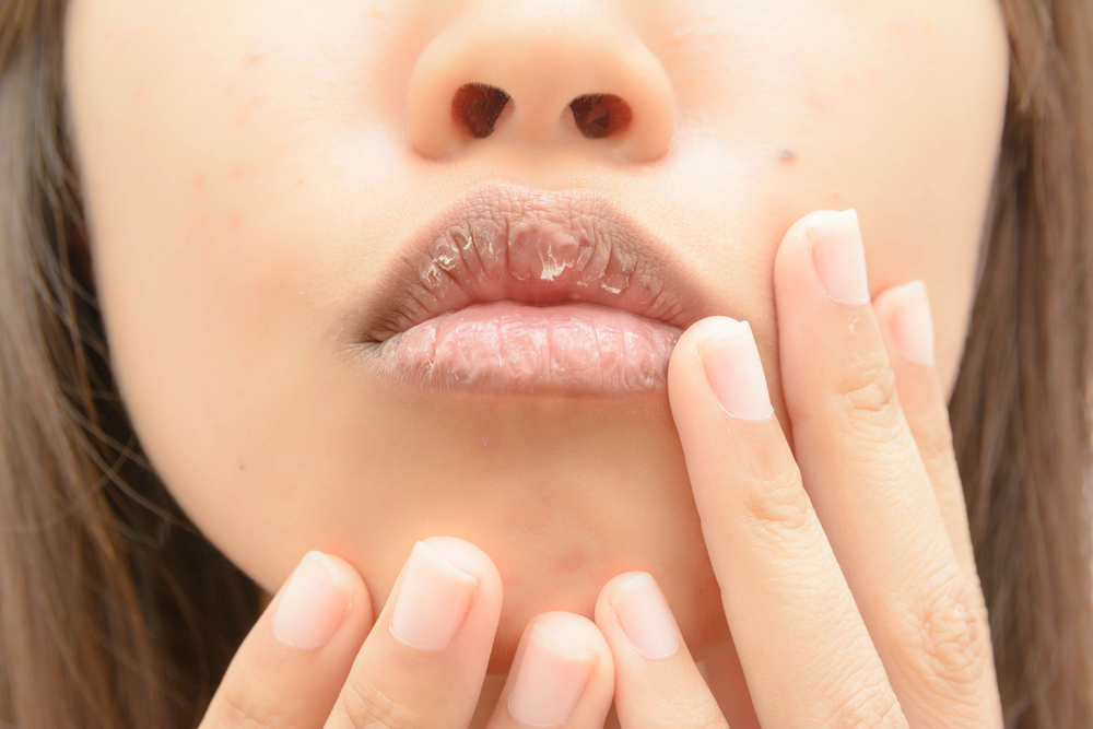 Labbra secche e screpolate: 5 cose che non devi assolutamente fare labbra secche