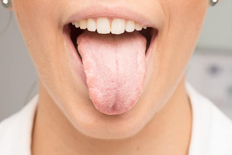Lingua bianchissima? Ecco le cause e 5 rimedi naturali lingua bianchissima